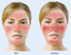 rosacea mild en moderate